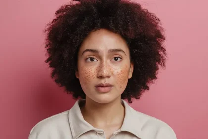 Akne Nedir ve Nasıl Tedavi Edilir?